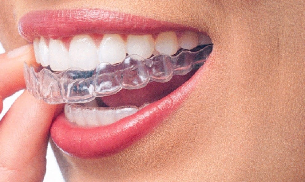 Insurance Cost  Clear Aligners